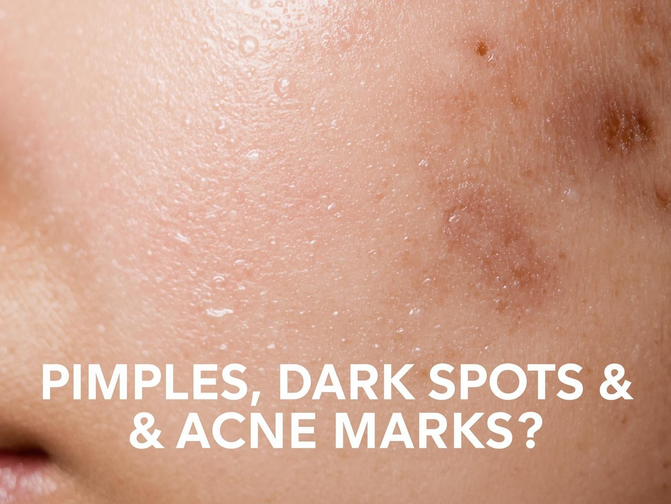 Pimples, Dark Spots & Acne Marks: What Actually Works?